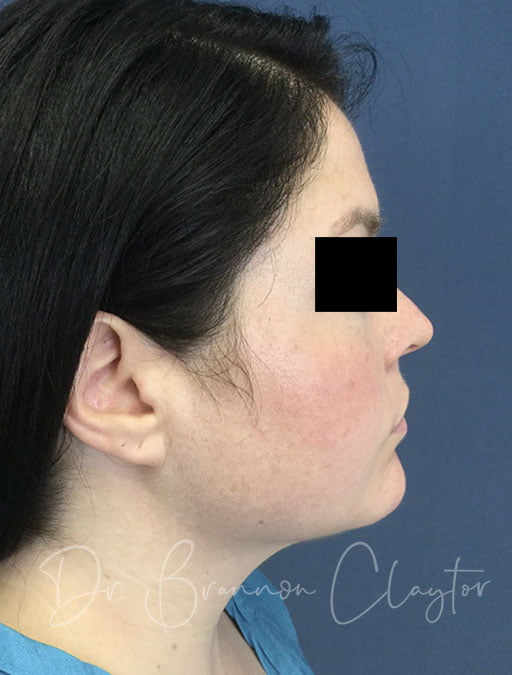 Smartlipo Neck