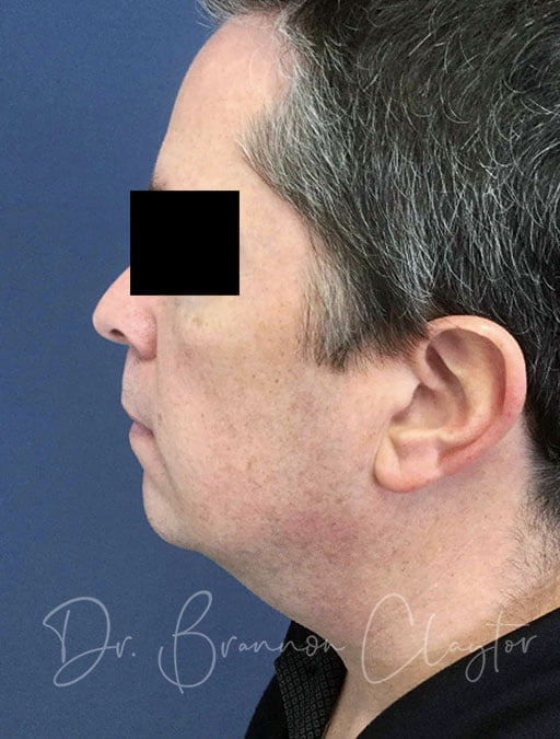 Smartlipo Neck