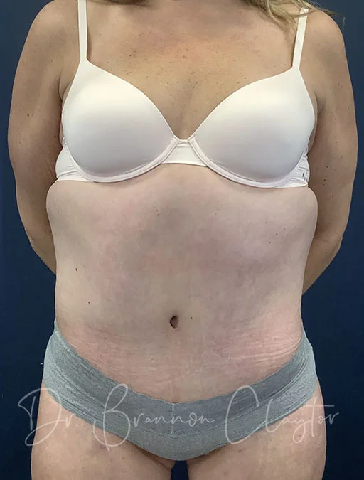 Tummy Tuck