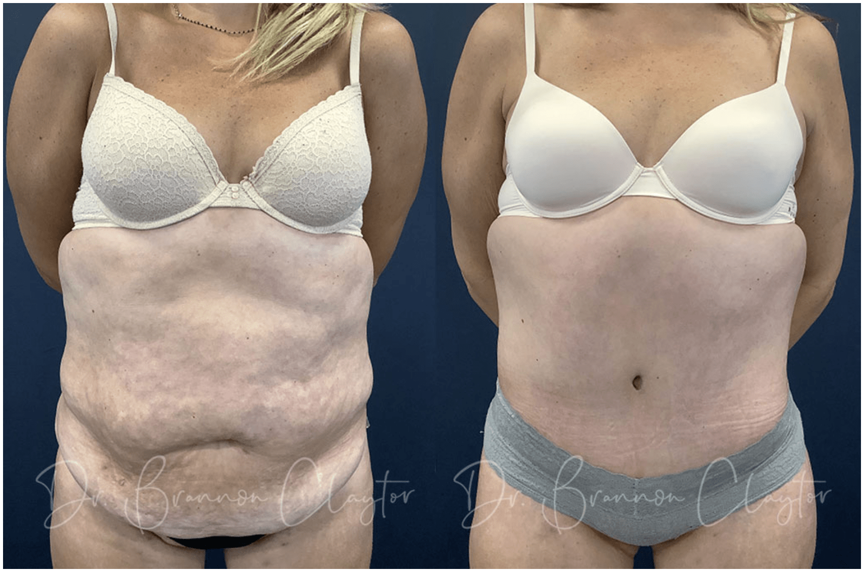 Dr. Brannon Claytor Tummy Tuck Patient 28