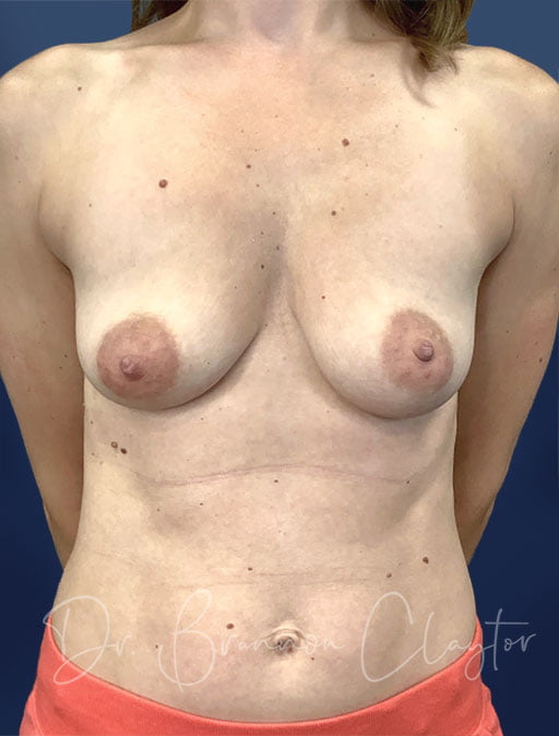 Breast Augmentation