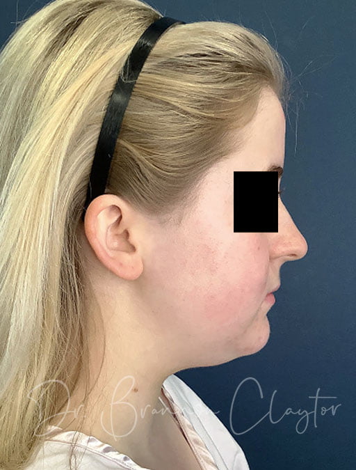 MyEllevate Neck lift with Neck Liposuction