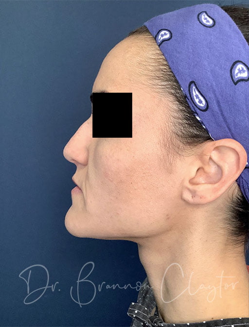 Rhinoplasty