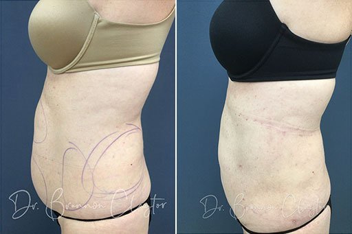 Before and After SmartLipo Patient