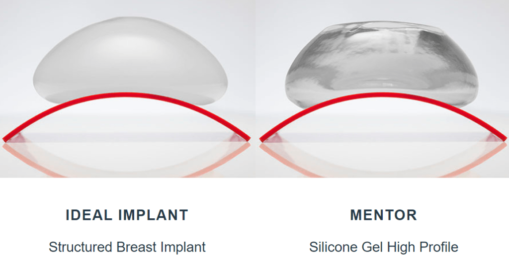 Ideal implant