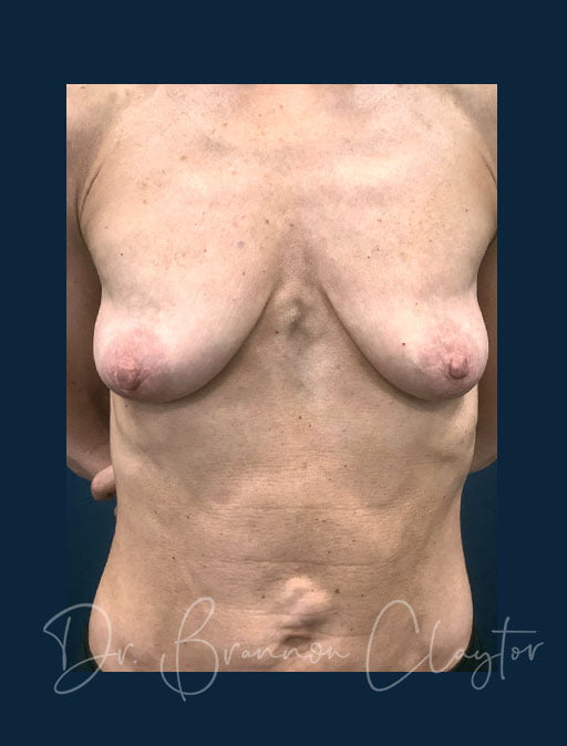 Breast Augmentation