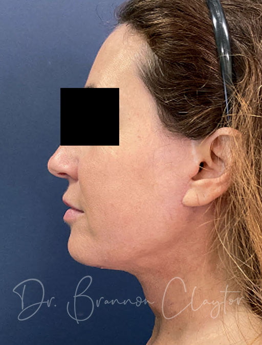 MyEllevate Neck lift