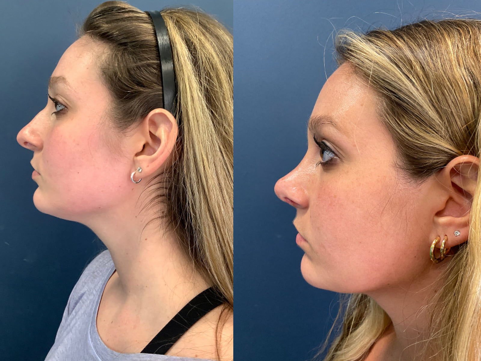 good nose job before and after