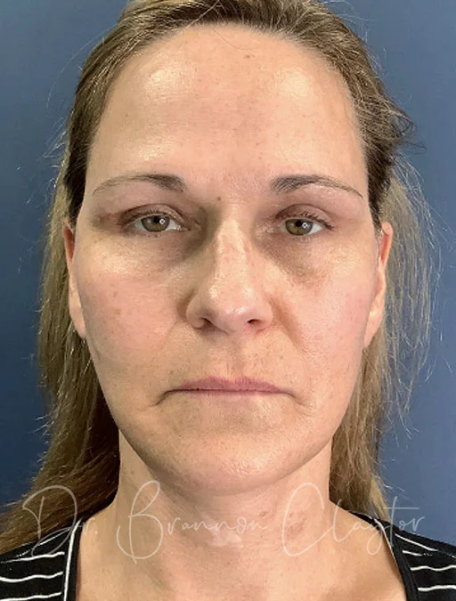 facelift-deep-plane-neck-lift-fat-grafting-49897a-after