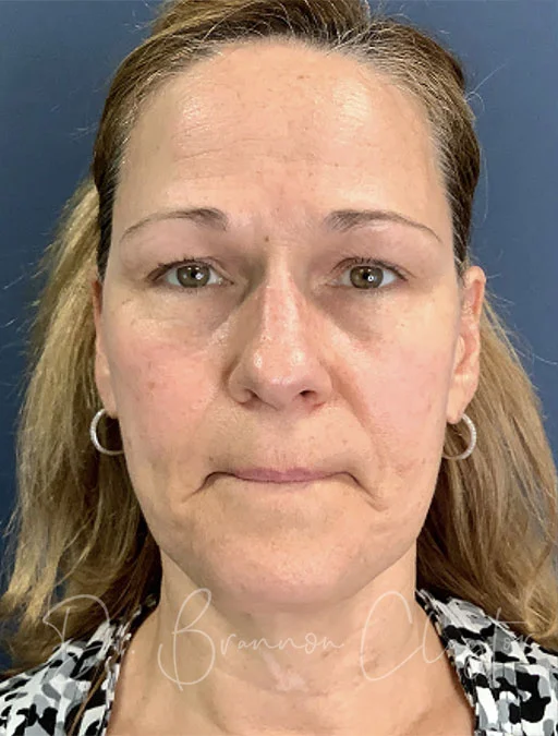 facelift-deep-plane-neck-lift-fat-grafting-49897a-before