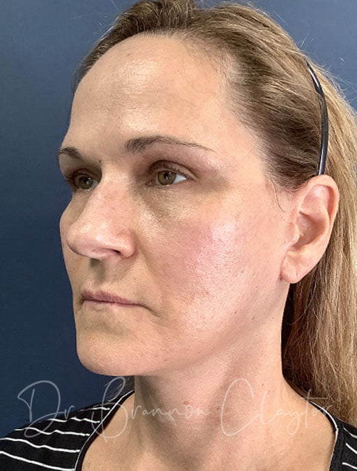 facelift-deep-plane-neck-lift-fat-grafting-49897b-after