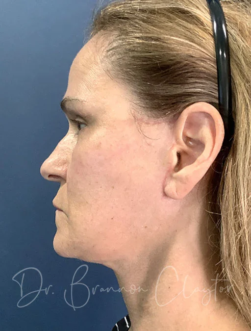 facelift-deep-plane-neck-lift-fat-grafting-49897c-after