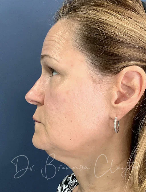 facelift-deep-plane-neck-lift-fat-grafting-49897c-before