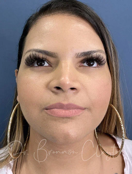 neck-lift-ellevate-smartlipo-49748a-after