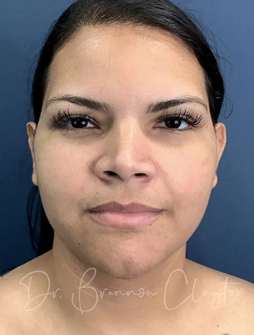neck-lift-ellevate-smartlipo-49748a-before