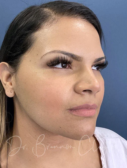 neck-lift-ellevate-smartlipo-49748b-after