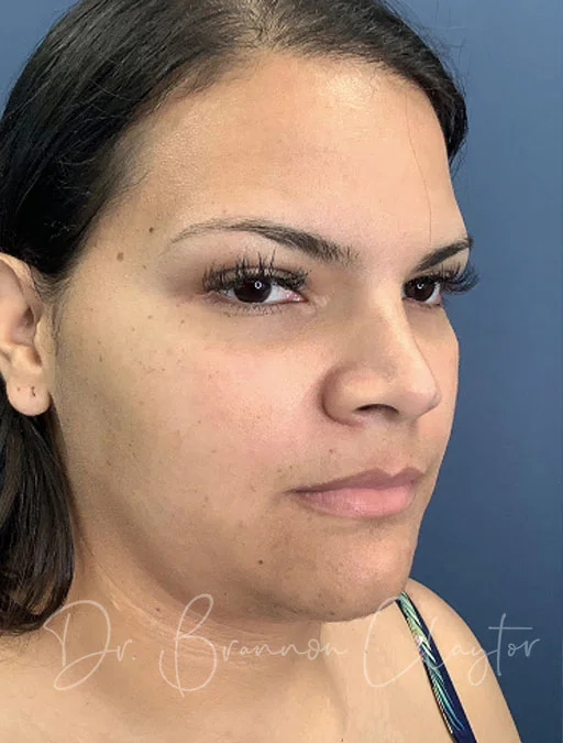 neck-lift-ellevate-smartlipo-49748b-before