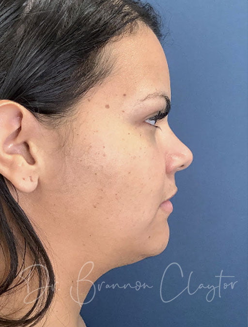 MyEllevate Neck lift