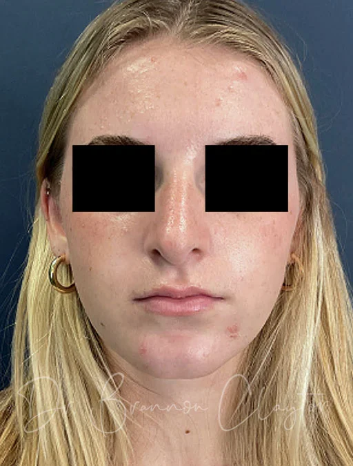 rhinoplasty-48326a-1year-after