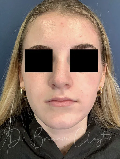 rhinoplasty-48326a-5weeks-after