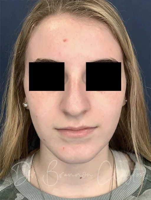 rhinoplasty-48326a-before