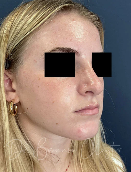 rhinoplasty-48326b-1year-after