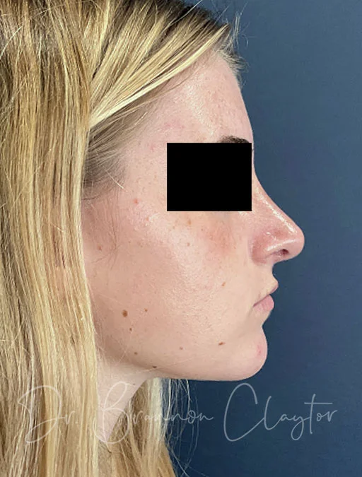 rhinoplasty-48326c-1year-after