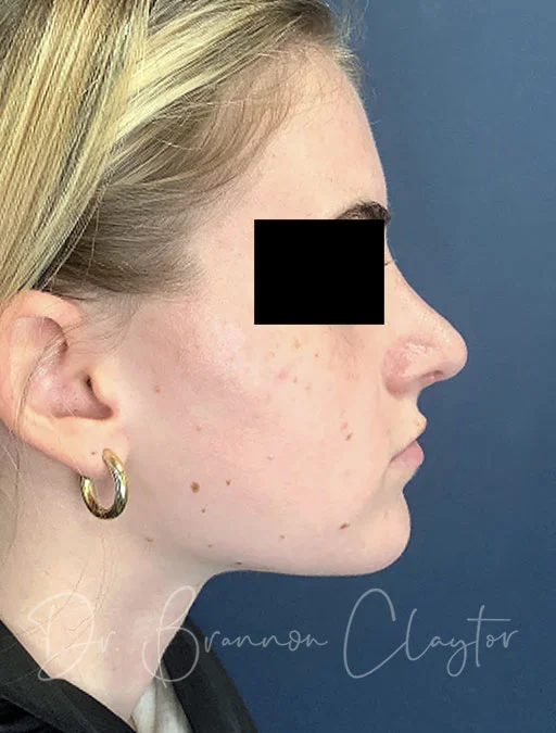 rhinoplasty-48326c-5weeks-after
