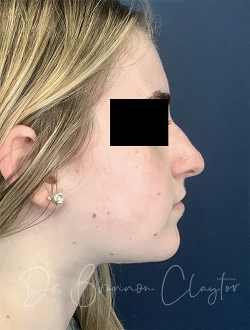 rhinoplasty-48326c-before