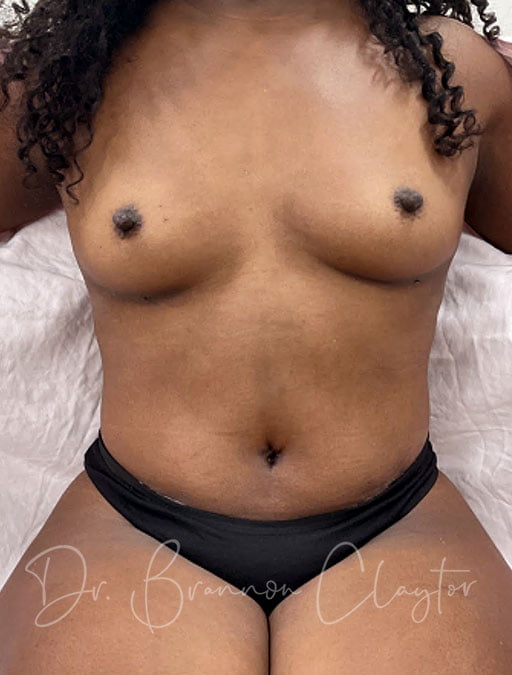 Tummy Tuck Drainless