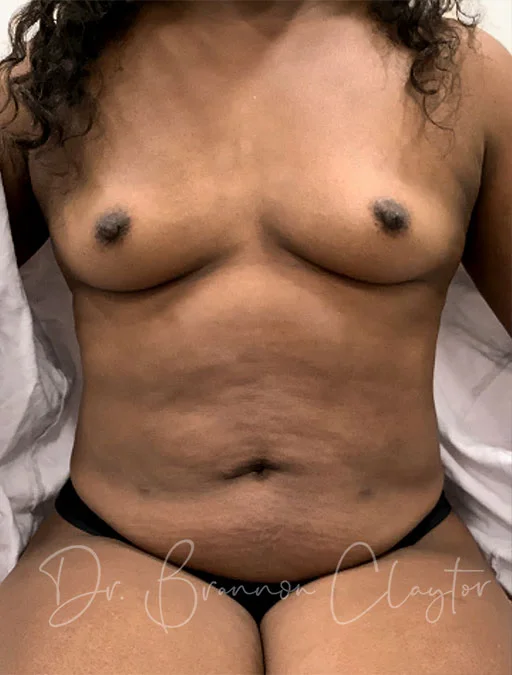 Tummy Tuck Drainless