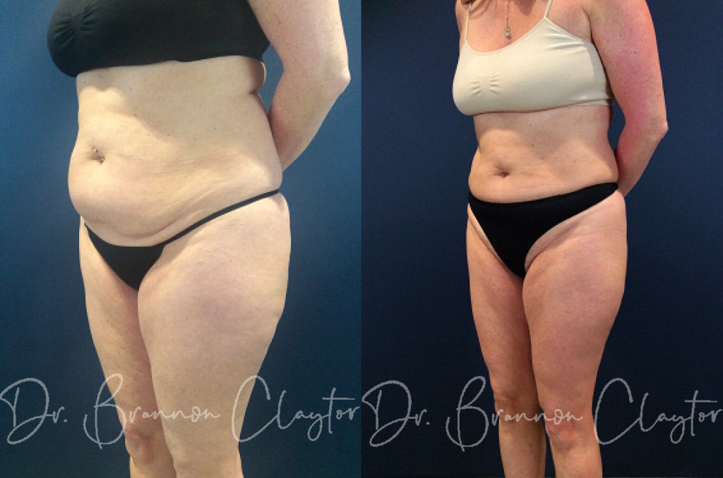 Before After CoolSculpting Patient 4912