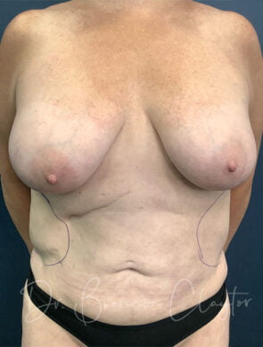Breast Lift with Liposuction