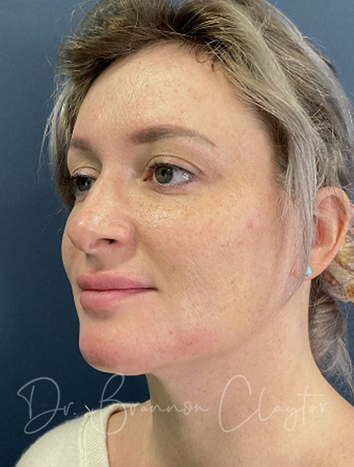 MyEllevate Neck Lift