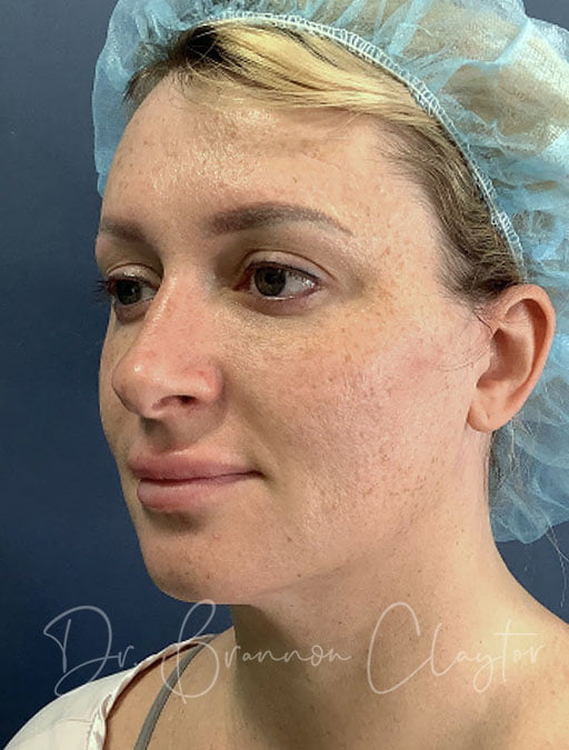 MyEllevate Neck Lift