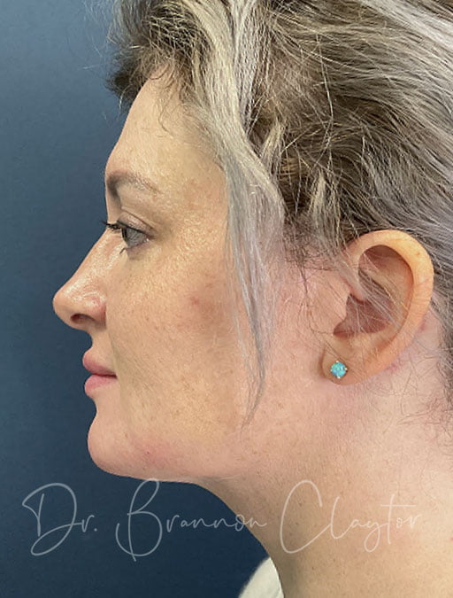 MyEllevate Neck Lift