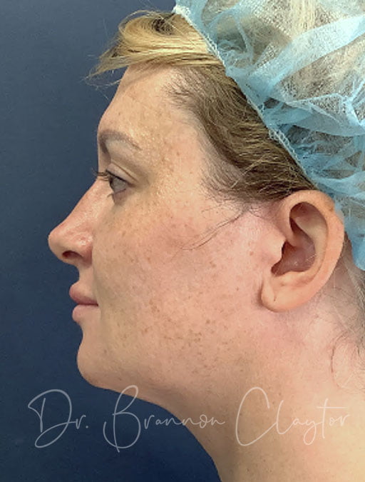 MyEllevate Neck Lift