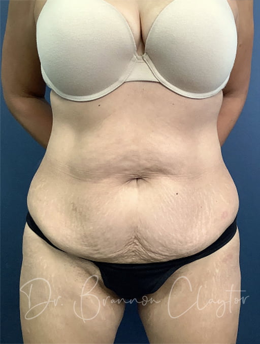 Drainless Tummy Tuck