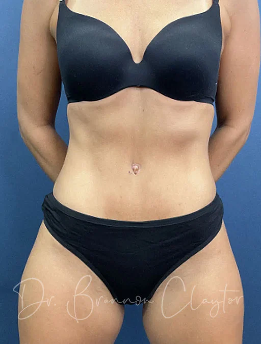 Drainless Tummy Tuck