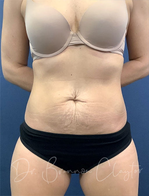 Drainless Tummy Tuck