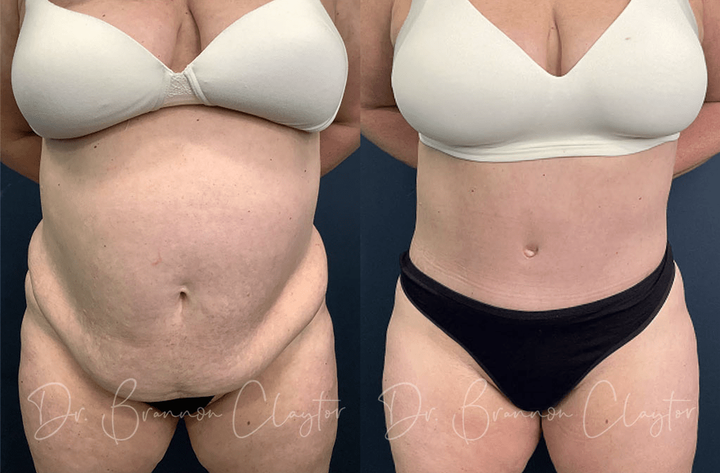 Dr. Claytor Drainless Tummy Tuck Results Before and After