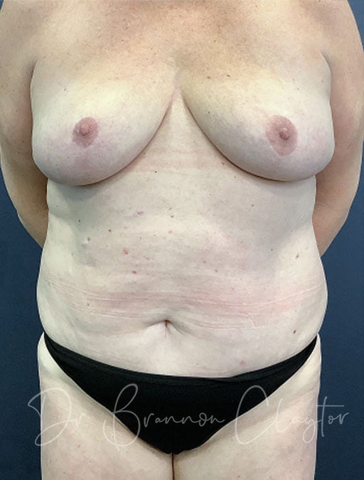 Drainless Tummy Tuck