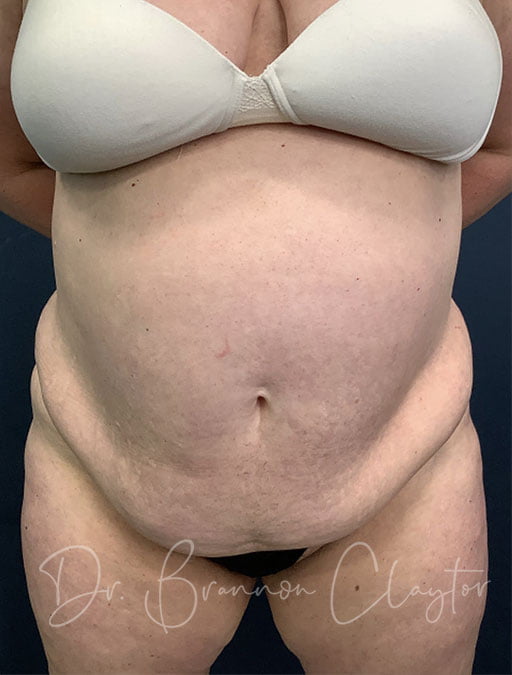 Tummy tuck pre-op photo