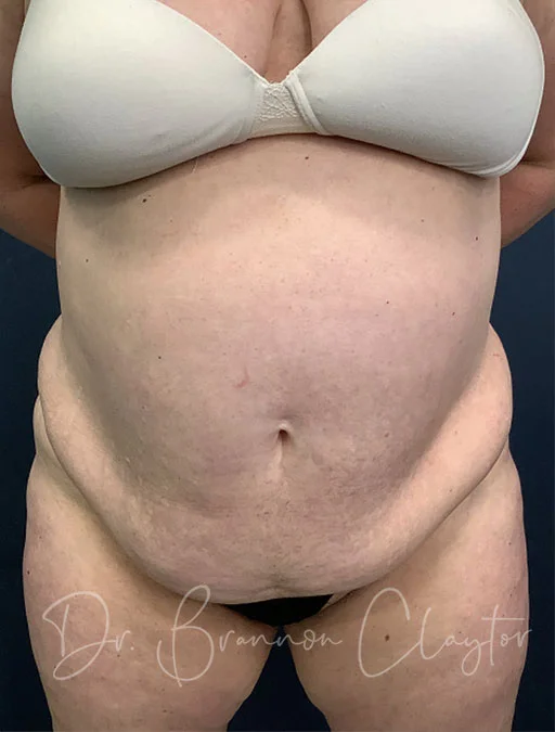 Drainless Tummy Tuck Akron