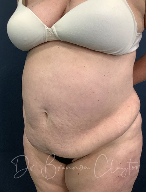 Drainless Tummy Tuck Akron