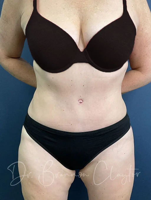Tummy Tuck Drainless