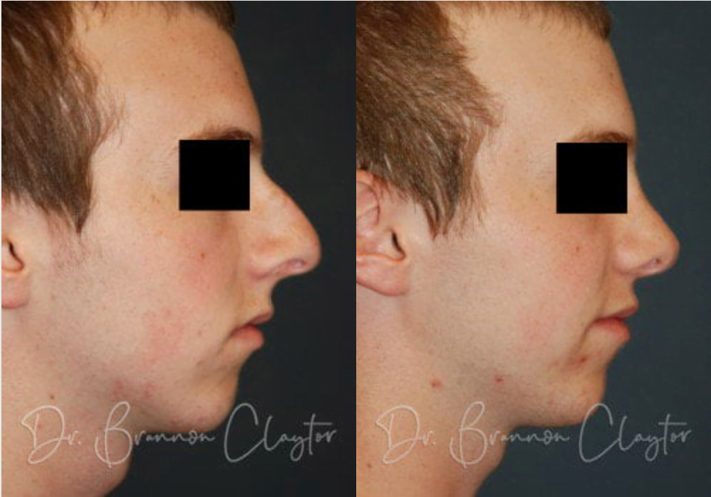 Male patient before and after rhinoplasty by Dr. Claytor