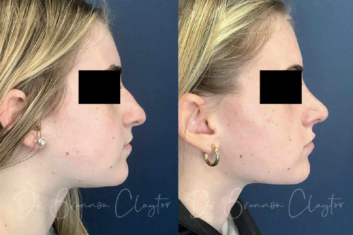 Philadelphia Rhinoplasty Before and After