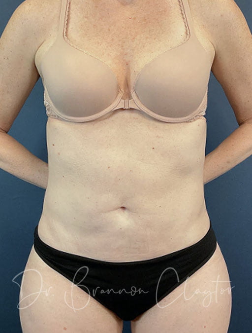 Smart Liposuction