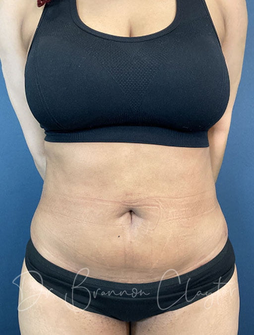 Smart Liposuction